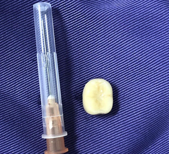 Hình ảnh chiếc răng được lấy ra từ lòng phế quản. Ảnh: Bệnh viện Bãi Cháy.