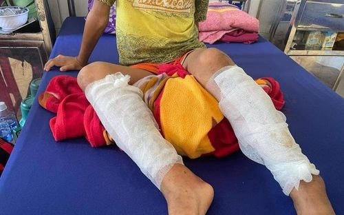 Cháu T. bị bỏng độ 3 cả 2 chân.