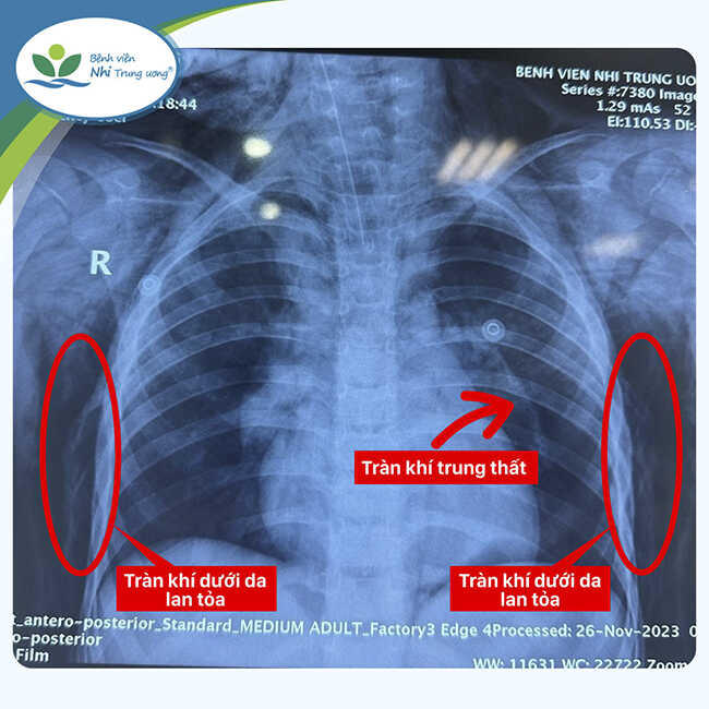 Bé trai 6 tuổi nguy kịch tính mạng vì chơi xe điện 3 bánh