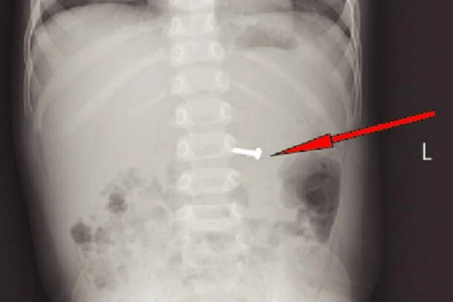 mai-choi-khong-de-y-chau-be-19-thang-tuoi-nuot-oc-vit-1-5cm.png