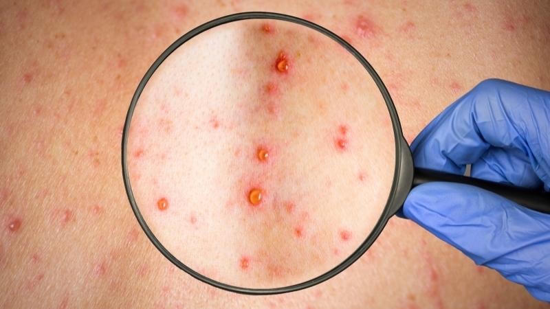 Một trong những biểu hiện của đậu mùa khỉ là xuất hiện nhiều mụn đỏ. Ảnh minh họa. 