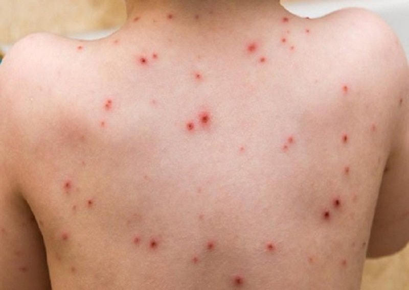 Ngành y tế khuyến cáo, hạn chế tiếp xúc gần với người nghi nhiễm đã mắc bệnh,hoặc với động vật có thể bị nhiễm bệnh...