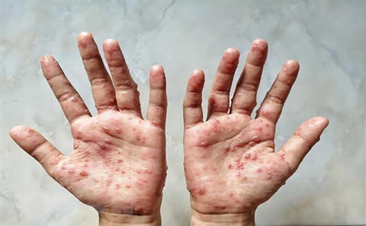 Các ban đỏ nổi trên tay một bệnh nhân mắc bệnh đậu mùa khỉ. Ảnh: Shutterstock/TTXVN.