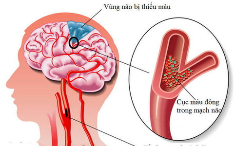 Cục máu đông là nguyên nhân chủ yếu dẫn tới đột quỵ nhỏ và đột quỵ.  
