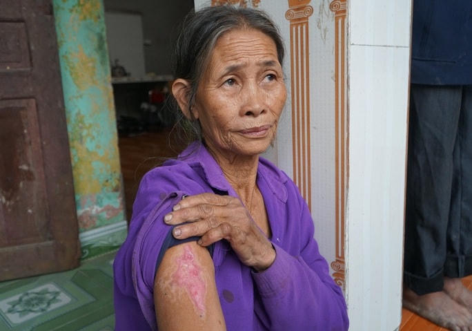 Bà Hà Thị Diến (mẹ ông Nam) bị bỏng ở tay khi cố gắng dập lửa.