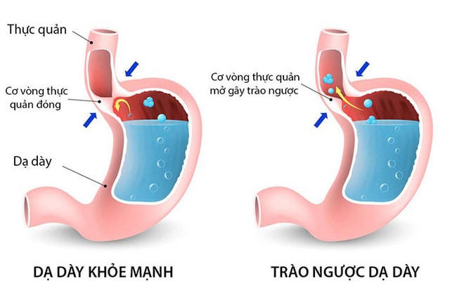Hình ảnh mô tả dạ dày, thực quản khỏe mạnh và khi bị trào ngược dạ dày - thực quản.