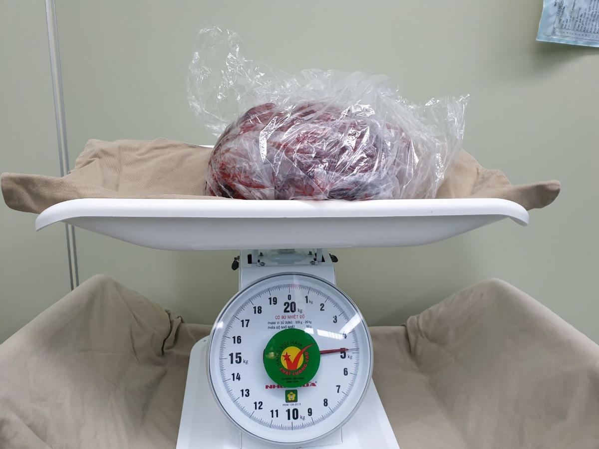 Khối u khổng lồ các kích thước gần 5kg. Ảnh: BVCC