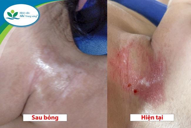 Vết thương trên cổ trẻ ngay sau khi bỏng (trái) và hiện tại.  