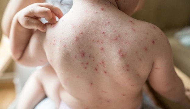 Người dân không nên chủ quan với bệnh thủy đậu. Nguồn: SKĐS.