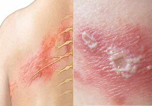 Triệu chứng đầu tiên của Zona thường là tăng cảm giác da hoặc cảm giác đau ở một phía của cơ thể. Ảnh minh họa.