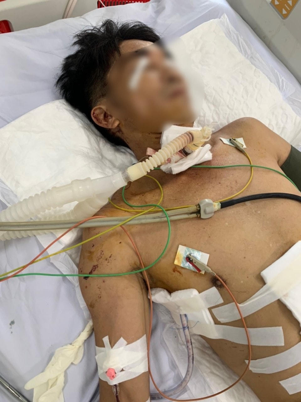 Bệnh nhân Ph. đang nằm điều trị tại bệnh viện.