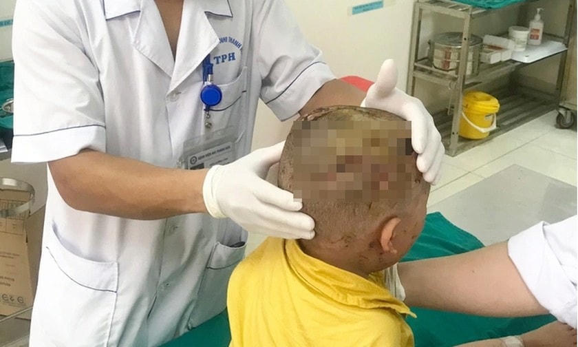 Bé trai 3 tuổi đang chơi thì bị chó nhà hàng xóm cắn vào vùng đầu.