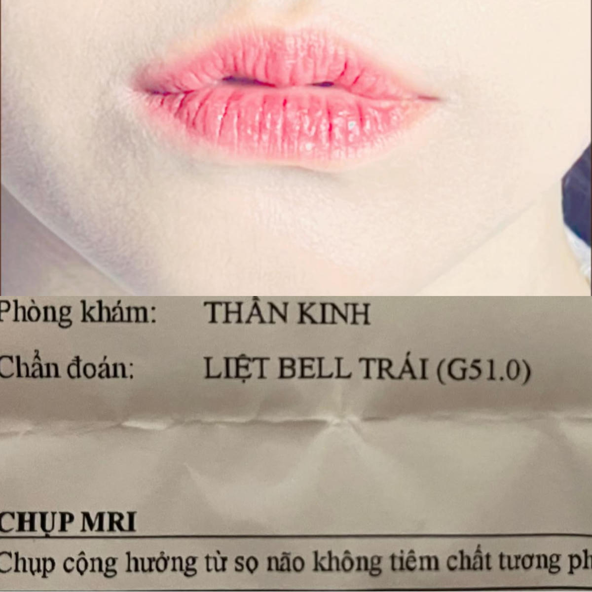 Hình ảnh giấy khám và miệng bị lệch của Hari Won.