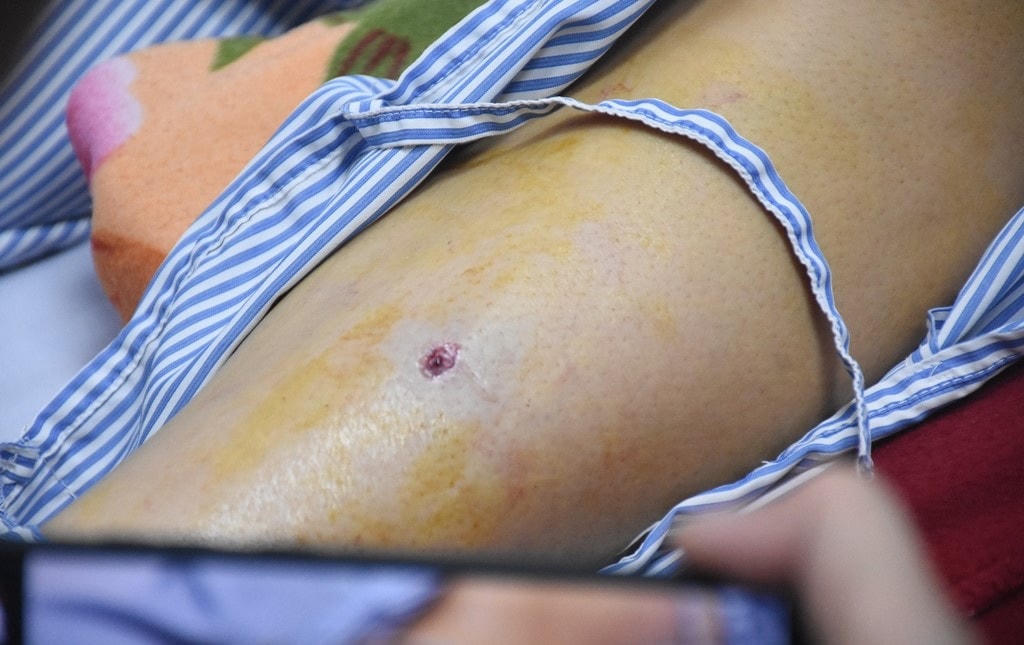 Vết thương của một nạn nhân.