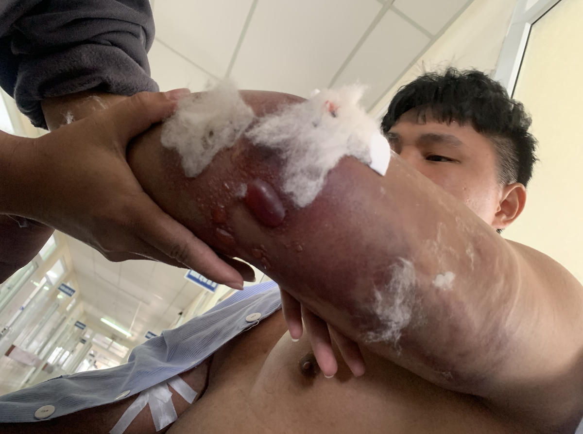 Cánh tay anh Đạt bị đánh gãy.