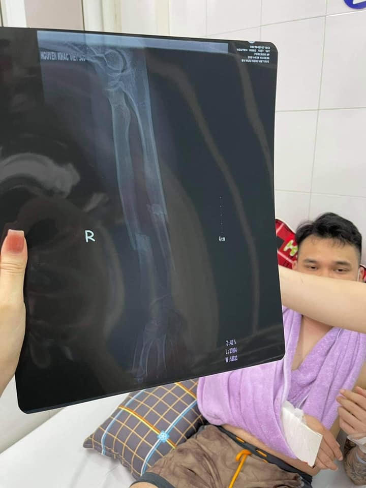 Hình ảnh phim chụp phần xương tay bị gãy của ca sĩ Khắc Việt được quản lý Hà Đoàn Đức đăng tải.