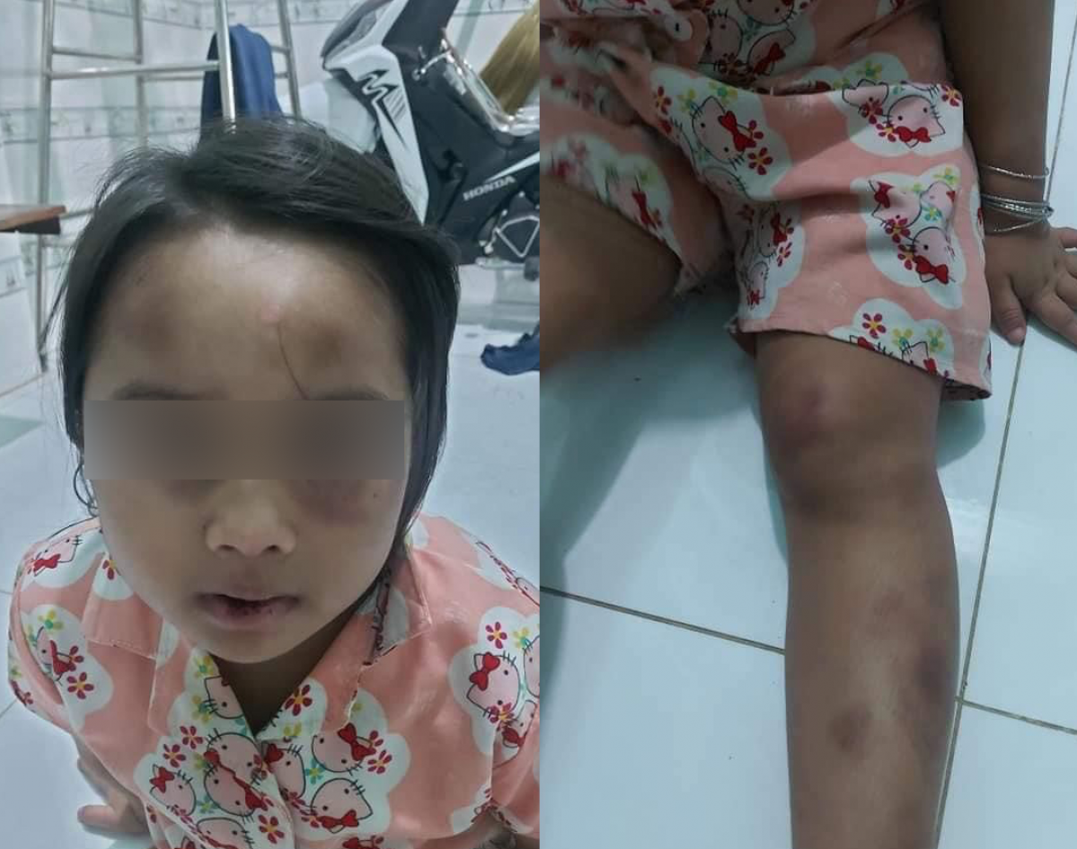 Trên người bé gái có nhiều vết bầm tím.