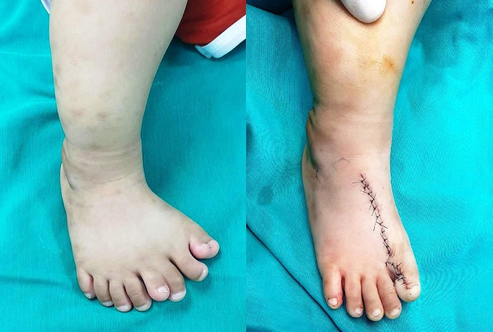 Ảnh trước và sau khi bệnh nhi Đào Trọng K. được phẫu thuật tạo hình.