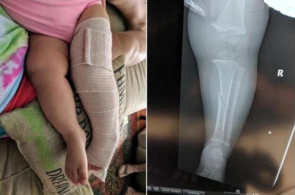 Hình ảnh khi bé Emelyn chơi cầu trượt cùng bố và bị gãy chân.