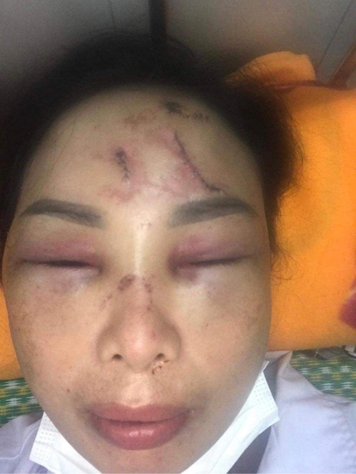 Bà Hoàn với các vết thương ở trán và mặt sau khi bị chồng tra tấn. 