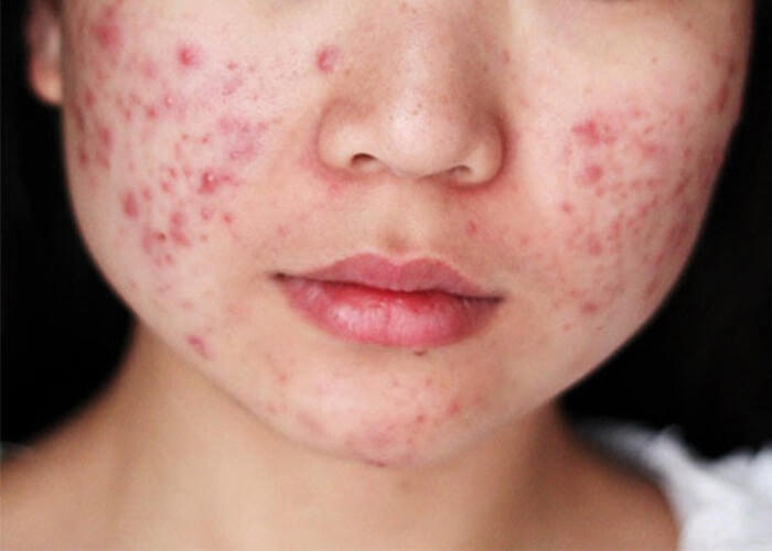 Mặt sưng tấy, chi chít mụn mủ đến bác sĩ còn khiếp chỉ vì đắp mật ong, trứng gà (ảnh minh họa).