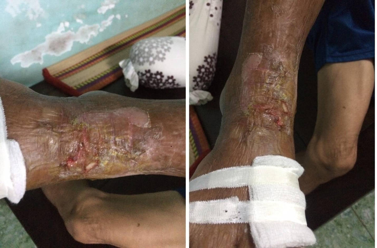 . Chân của ông G bị lở loét do thường xuyên tiếp xúc với nước dưới Rạch Mọi