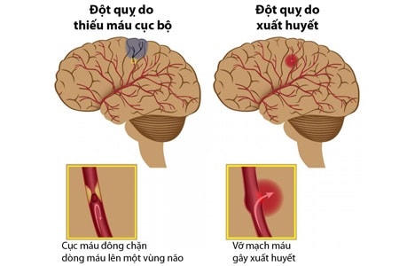 Nguy cơ đột quỵ ở người cao tuổi vào những ngày lạnh khá cao. (Ảnh minh hoạ)
