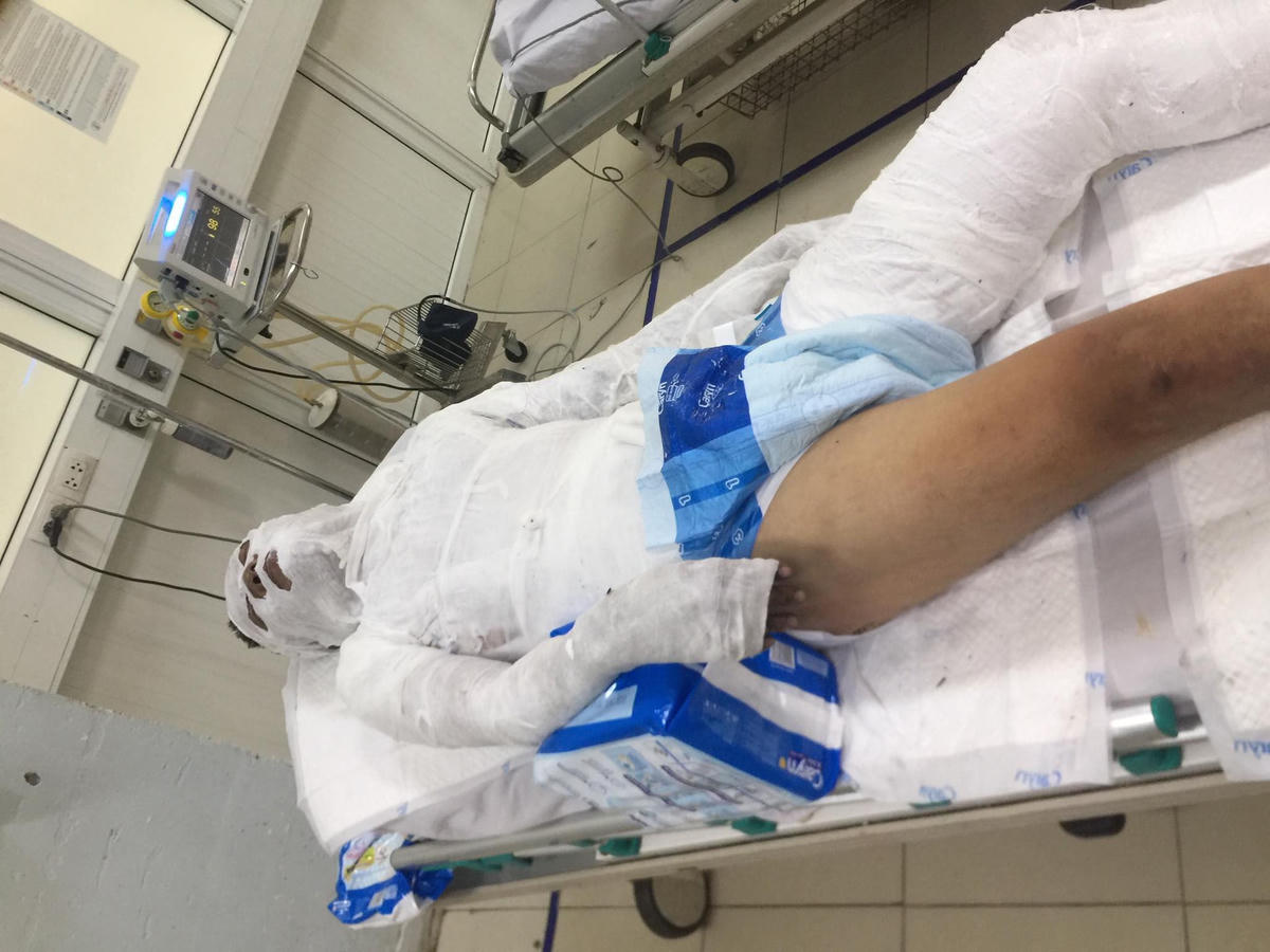 Anh Phạm Ngọc S. bị bỏng nặng, hiện đang điều trị tại BV Bỏng Quốc gia.