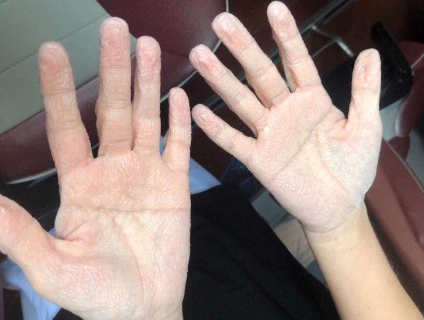 Hình ảnh bàn tay của Hoàng Phương Linh sau ngày làm việc gửi về cho mẹ. Ảnh: NVCC.