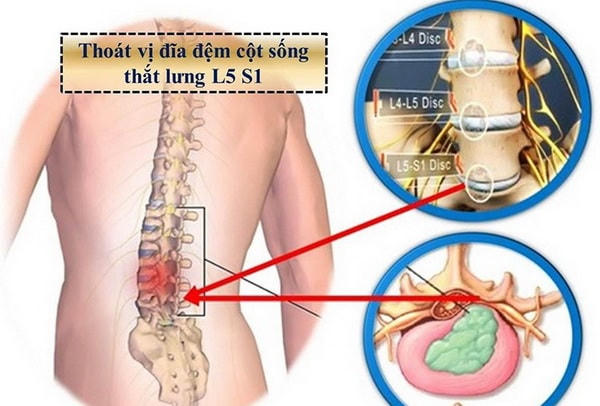 Hình ảnh thoát vị đĩa đệm cột sống thắt lưng.