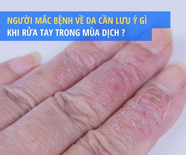 Người mắc bệnh về da cần lưu ý gì khi rửa tay trong mùa dịch Covid-19?