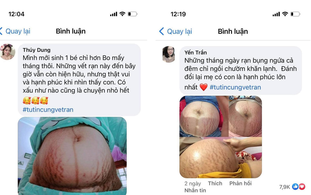 Vết rạn da sau khi mang thai mà các mẹ bỉm sửa.chia sẻ trong trào lưu thử thách khoe vết rạn mà Hòa minzy vận động. Ảnh: Chụp màn hình