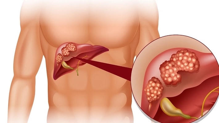 Những rủi ro sức khỏe lớn nhất đối với nam giới