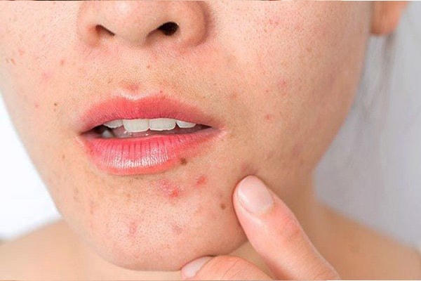Thiếu vitamin A có thể gây mụn ở má, cánh tay và đùi.