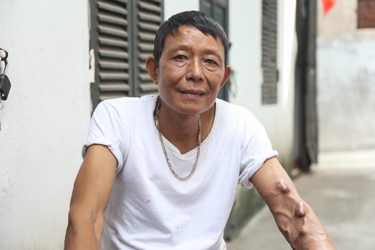 Ông Hồng  56 tuổi quê ở Hưng Yên kê chiếc bàn nhựa con ra ngoài sân, vừa rót nước mời, ông vừa kể: “Không cần nói đến dịch, bình thường anh em chúng tôi cũng đã quá vất vả rồi. Luôn phải nghĩ xem làm thế nào để kiếm được tiền, trả tiền thuê nhà trọ, tiền ăn, tiền thuốc men, tiền đi vào viện chữa trị để và tiền sinh hoạt giúp đỡ cho gia đình. Bình thường nếu như không có dịch thì những người đang bị bệnh như chúng tôi sử dụng thực sự tiết kiệm thì mỗi tháng tiêu hết khoảng 2,5-3 triệu đồng ”