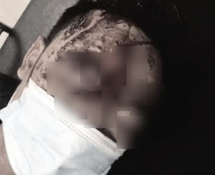 Nạn nhân H. sau khi bị tấn công khi đang ngủ.