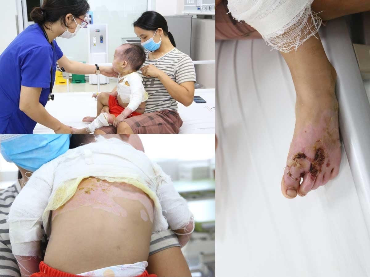 Các vết bỏng ở trẻ đã lên da non, sức khỏe bệnh nhi đã tiến triển rất nhiều. Ảnh: BVCC