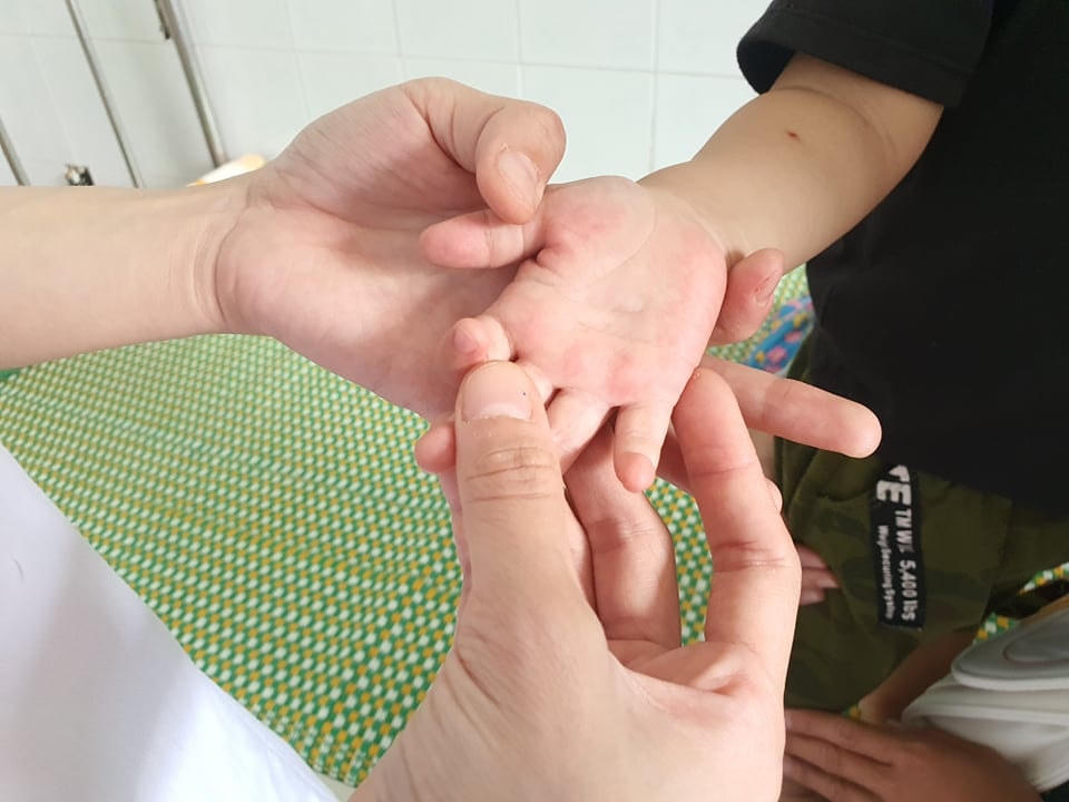 Nguy cơ bùng phát bệnh tay chân miệng
