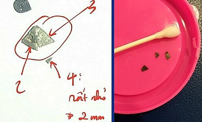 Các mảnh vụn dao lam được tìm thấy trong phân sau khi bé đi tiêu. Ảnh do bệnh viện cung cấp.  