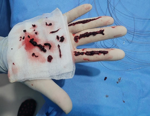 Một bệnh nhân bị đột quỵ may mắn được các bác sĩ can thiệp kịp thời, lấy máu đông tái thông mạch máu.  