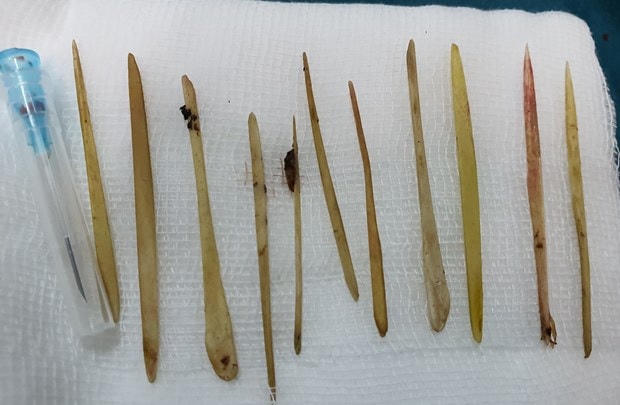 11 que tăm được lấy ra khỏi ruột non ông T. (Nguồn: congan.com.vn).