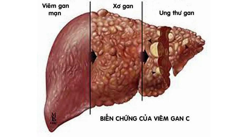 Virus viêm gan C - sát thủ thầm lặng
