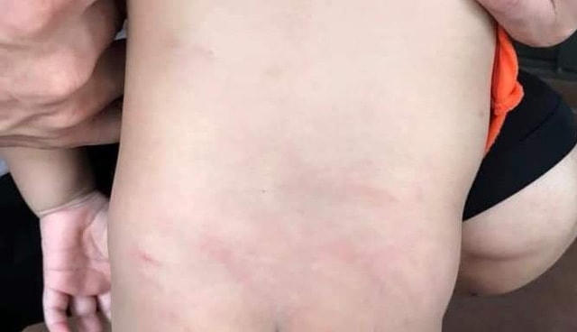 Vết tấy đỏ ở phần lưng và mông con chị Ngọc.