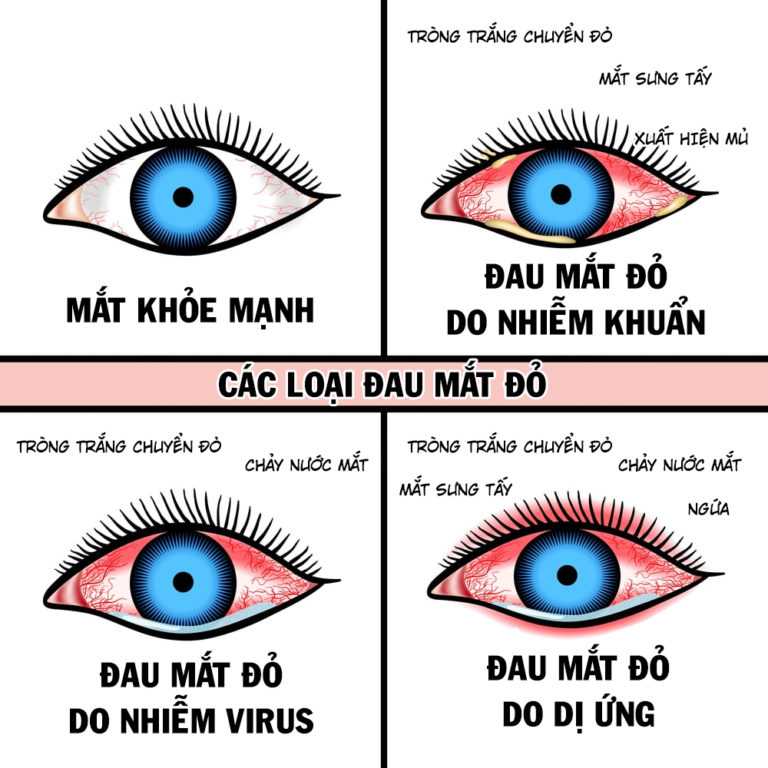 Cách phòng bệnh và chăm sóc đôi mắt