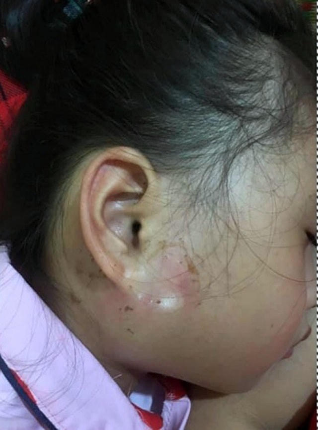 Bé gái 8 tuổi bị viêm tuyến nước bọt mang tai.