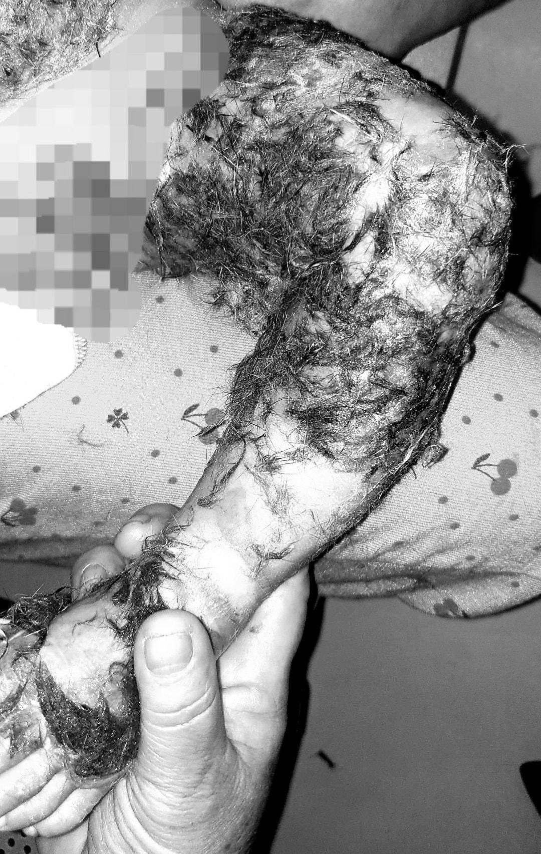 Những vết bóng của cháu bé 8 tháng tuổi được thầy lang đắp toàn lông chó vừa phản khoa học vừa nguy hiểm đến tính mạng