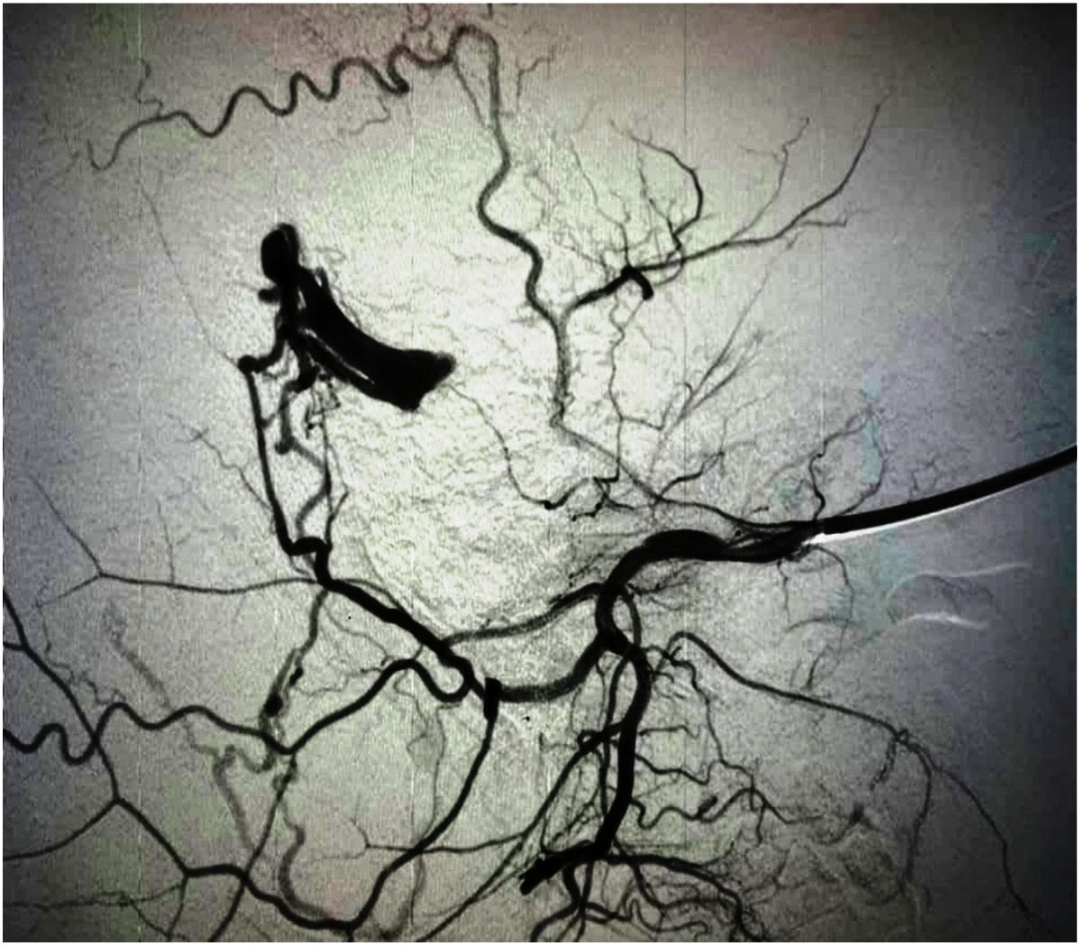Động mạch cảnh ngoài dò vào xoang tĩnh mạch sigma.