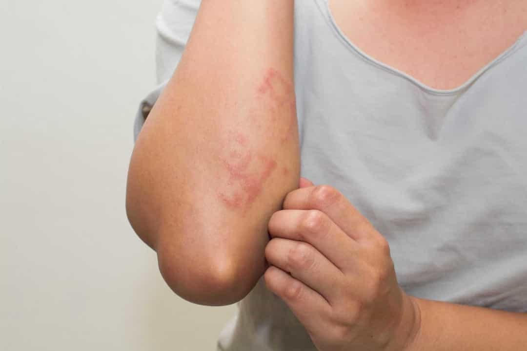 Dị ứng - Sữa đứng đầu danh sách các loại thực phẩm dễ gây dị ứng.