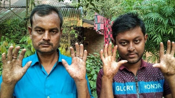 Các thành viên trong gia đình Sarker đều không có dấu vân tay.