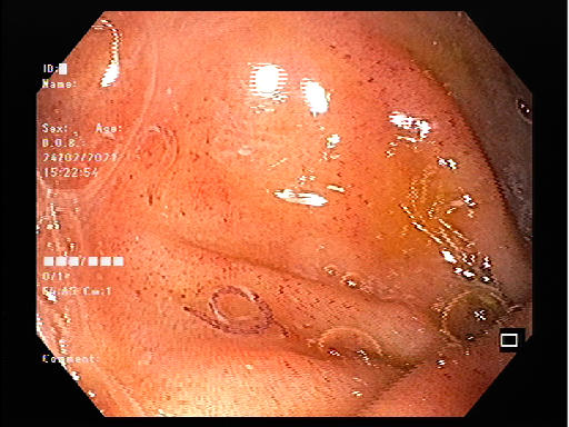 Hình ảnh sán qua hệ thống nội soi.